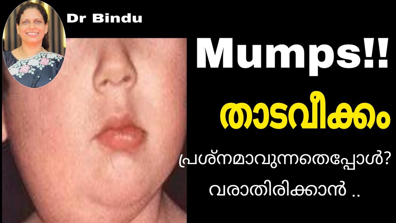 താടവീക്കം/മുണ്ടിനീര്/Mumps/ പ്രശ്നക്കാരനാവുന്നതെപ്പോൾ/വരാതിരിക്കാൻ എന്തു ചെയ്യാം/Dr Bindu