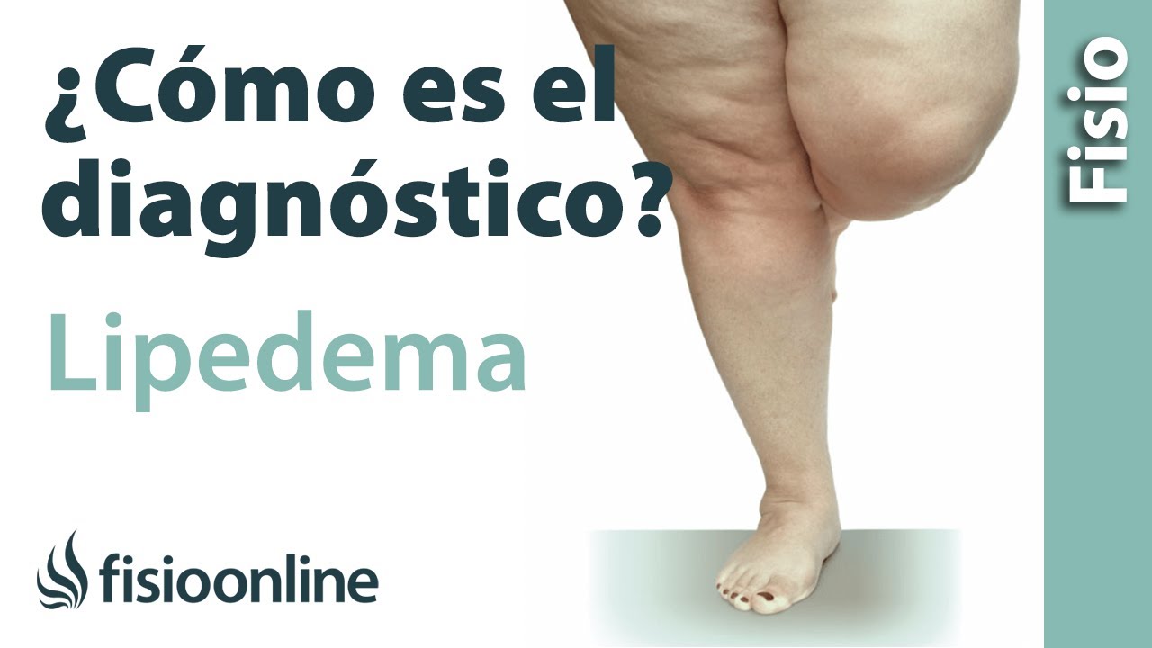 ¿Cómo SABER si tengo LIPEDEMA? signos y síntomas para el DIAGNÓSTICO 🦵🏻