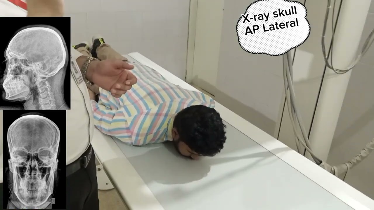 skull x-ray position AP Lateral in Urdu Hindi#doctor #hospital #dr #mbbs