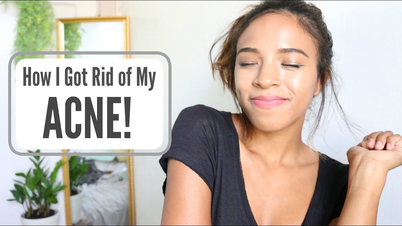 GET RID OF YOUR ACNE FOREVER! SERIOUSLY WORKS!