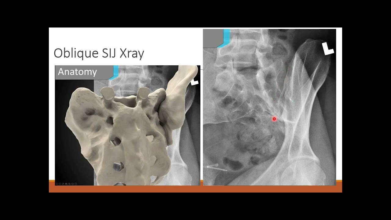 MRI of the sacroiliac joint
