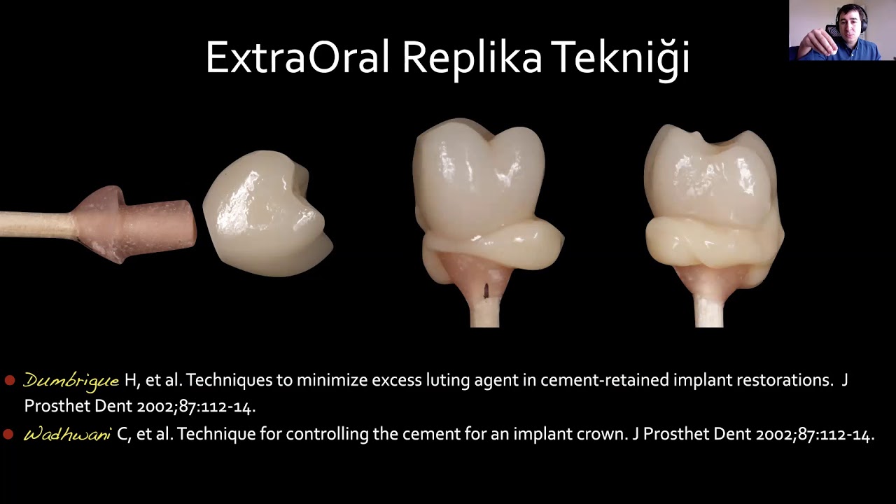 Dr. Mehmet DİKMEN / İmplant üstü restorasyonlarda simantasyonun püf noktaları