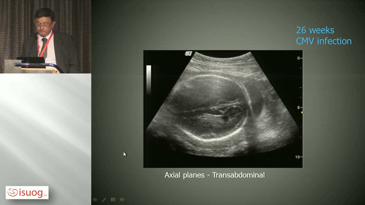fetal brain in CMV