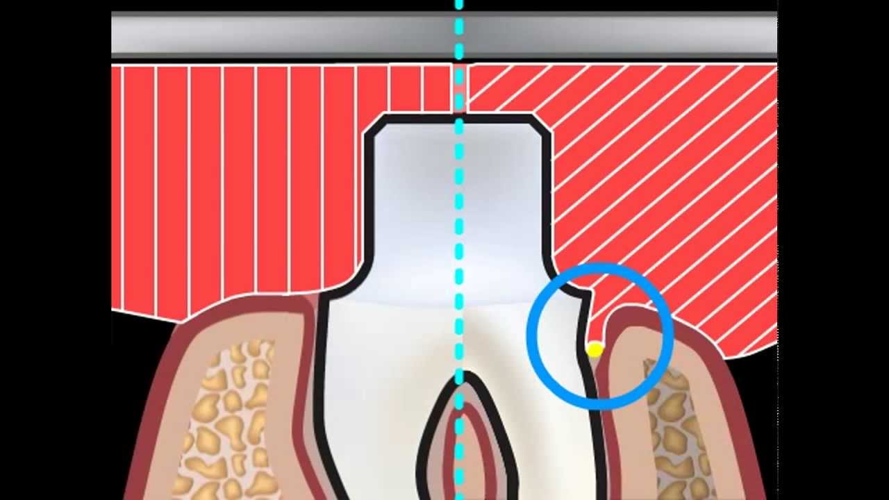 Filo di retrazione per impronta dentale ottimale