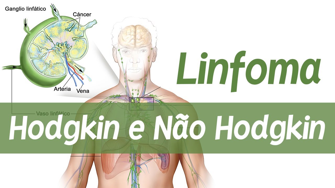 Linfoma de Hodgkin e Não Hodgkin │ Fisiopatologia e Patologia