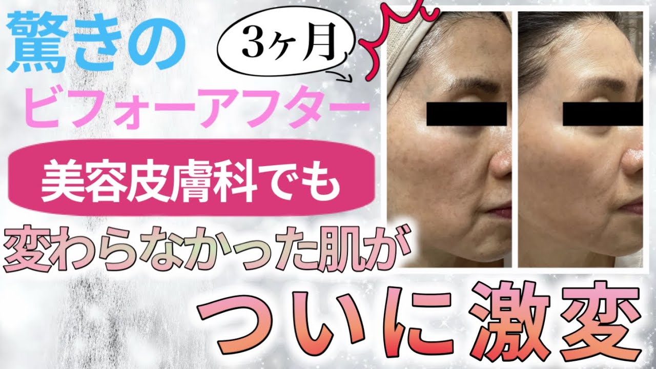 【驚きの3ヶ月ビフォーアフター】美容皮膚科でも変わらなかった肌がついに激変！