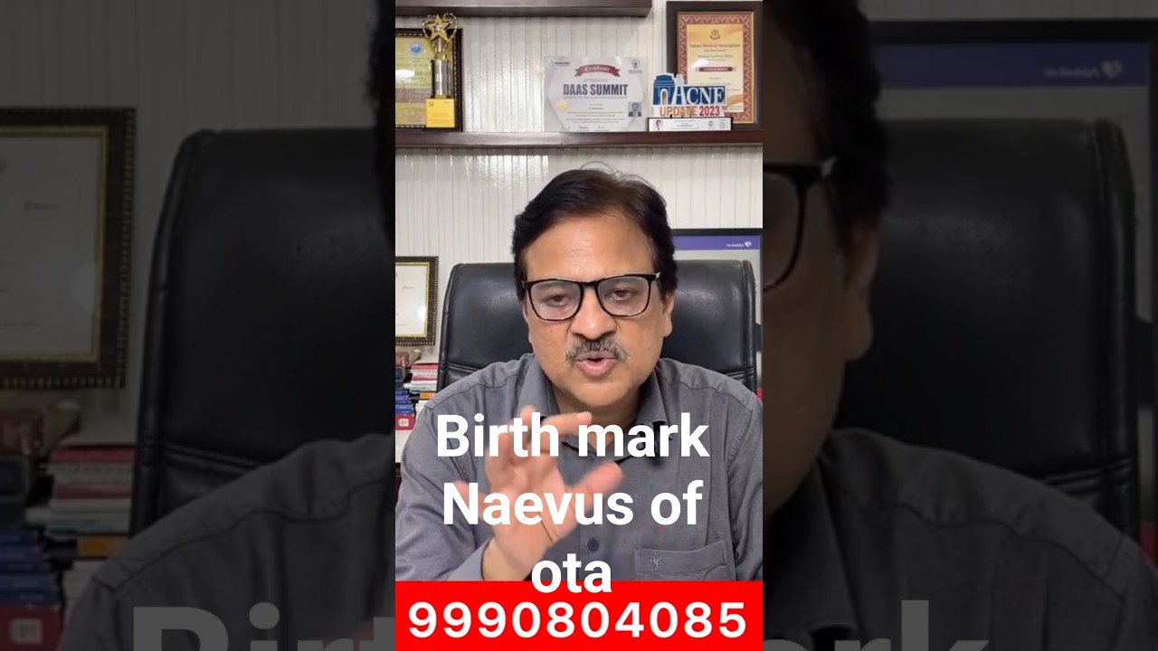 Face Birthmark- How to remove it? Laser Treatment by Dr. Sandesh Gupta