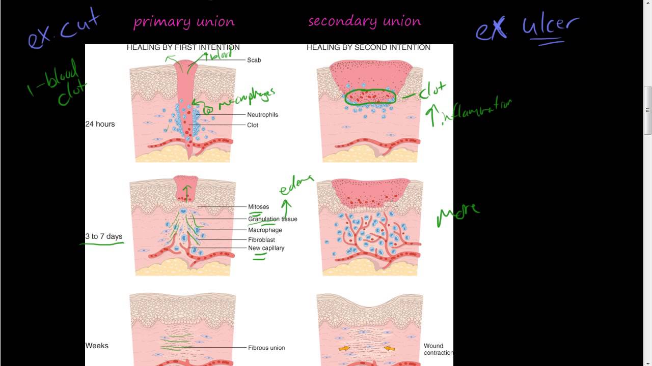 #41-Healing by First and Second Intention, Wound Strength