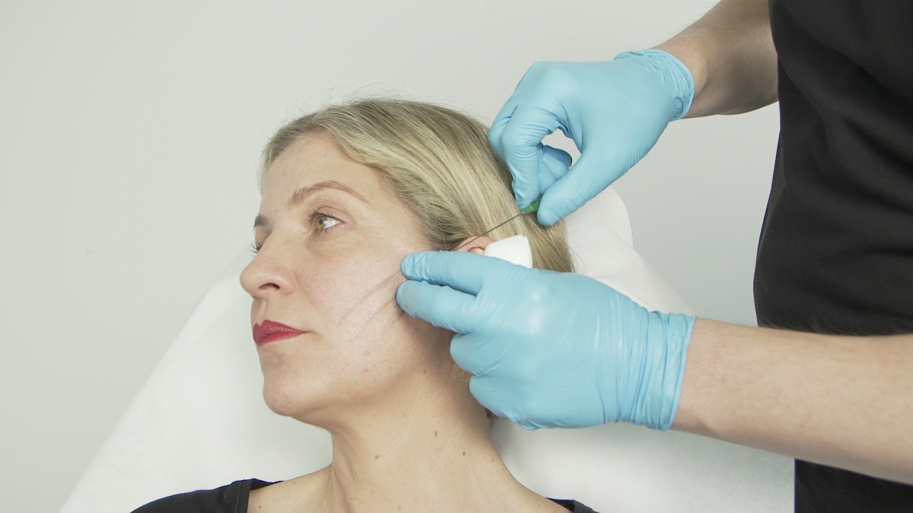 Fadenlifting | skinmed - Plastische und &Auml;sthetische Chirurgie und Dermatologie