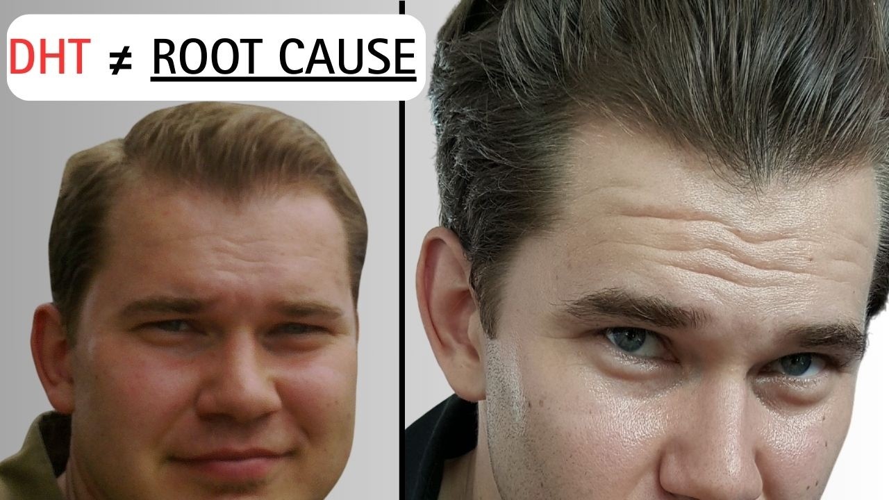 Scalp Inflammation Is What Makes DHT Dangerous