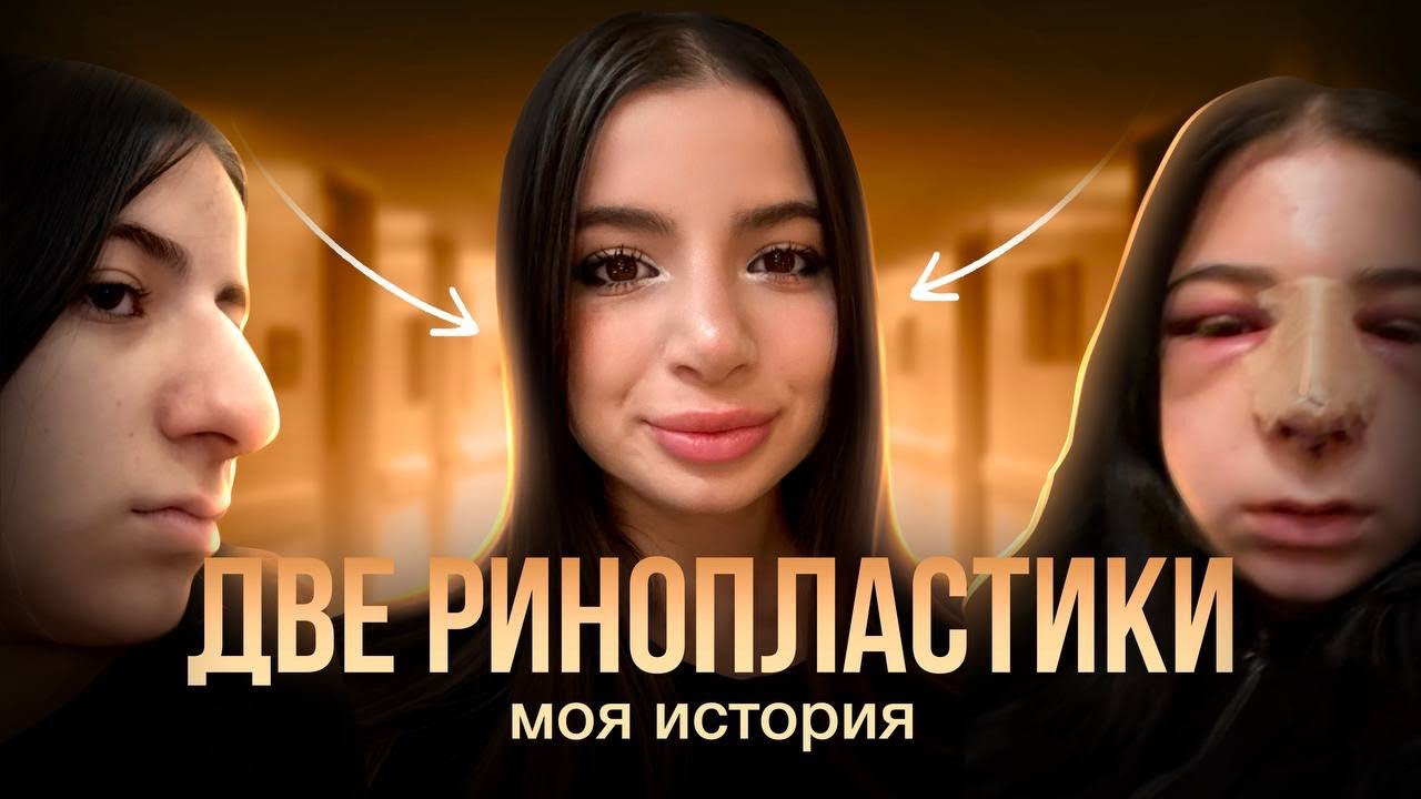 ДВЕ РИНОПЛАСТИКИ | шрам на всю жизнь