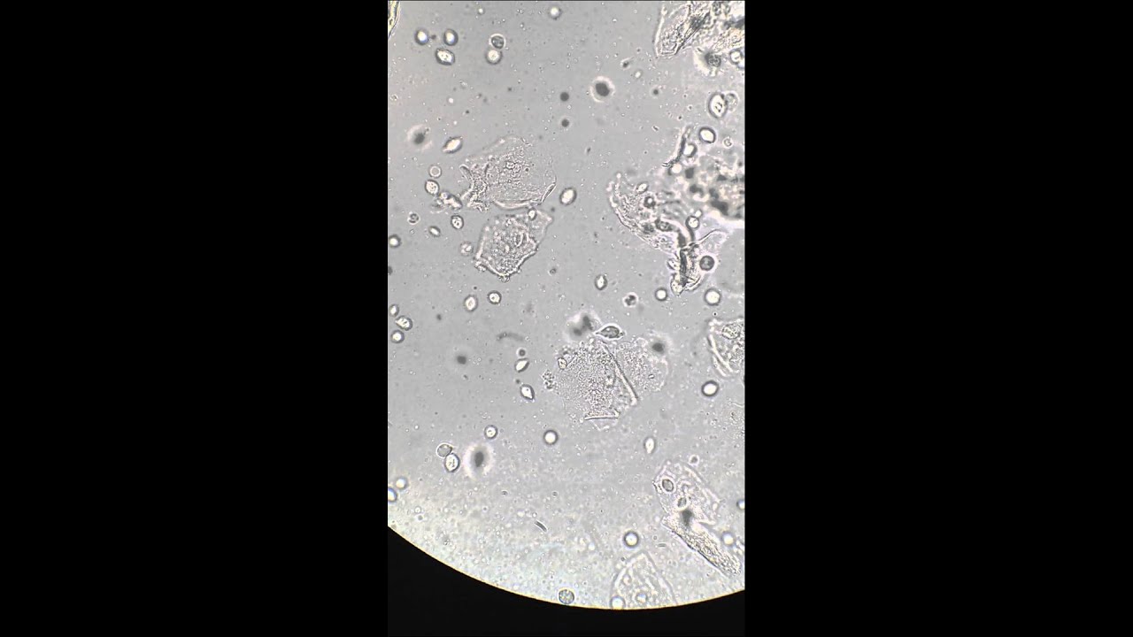 Trichomonas vaginalis in urine at 400x