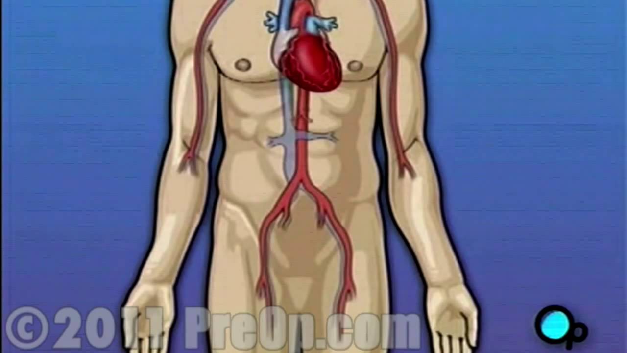 Asian Heart Hospital - Latest bypass surgery without the usage of pump