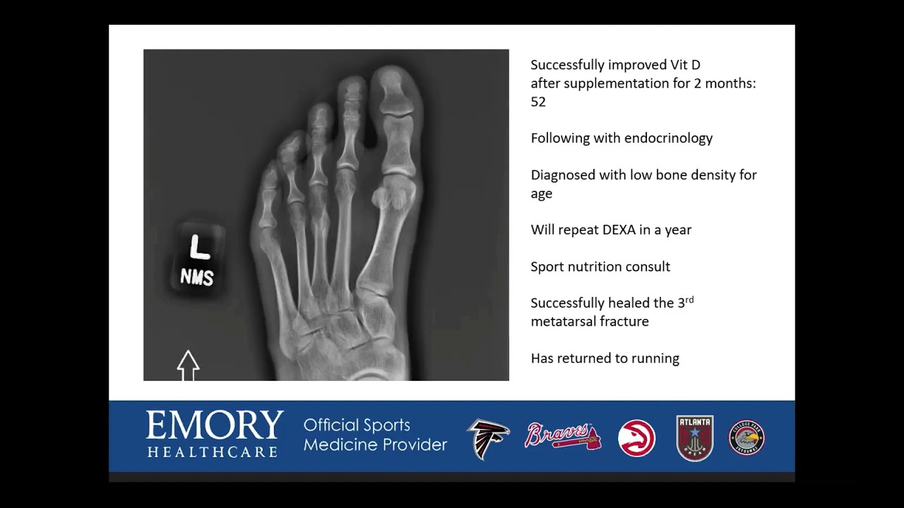Relatively Energy Deficiency in Sports