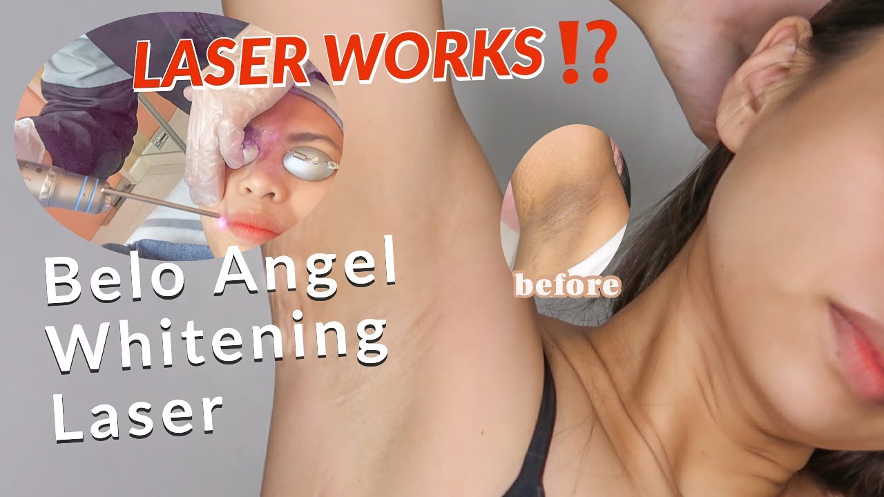 HOW I LIGHTEN MY UNDERARM + Face Belo Angel Whitening Laser Treatment
