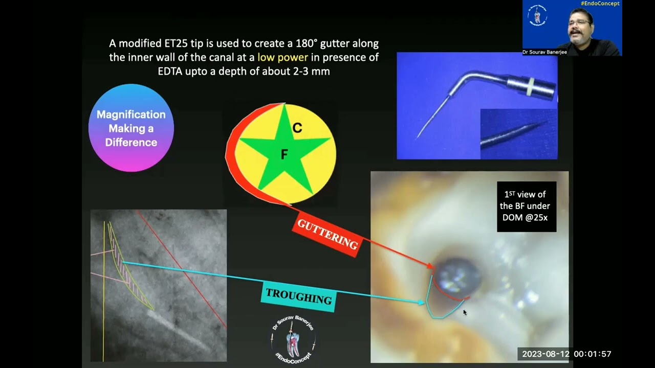 Separated File retrieval | Improvisation | Microscope | Root Canal Treatment #endoconcept #viral