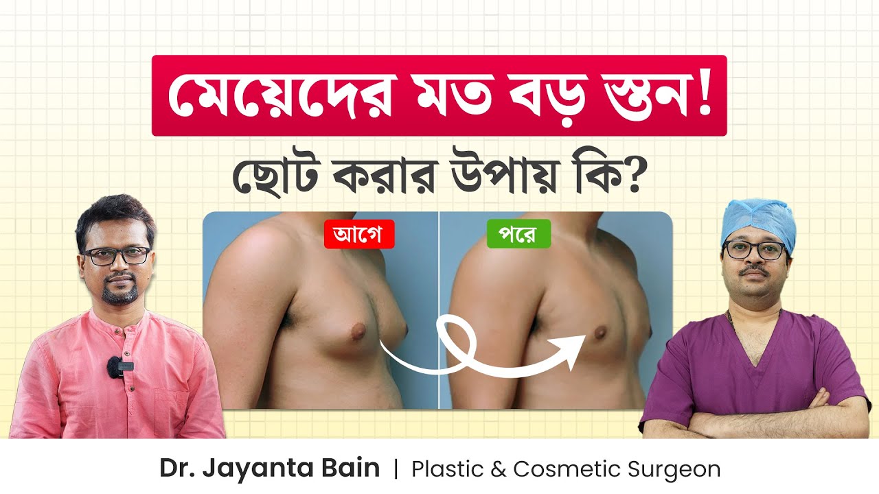 ছেলেদের বড় স্তন কমানোর উপায় | গাইনেকোমাস্টিয়া থেকে মুক্তির উপায় | Gynecomastia | Dr. Jayanta Bain