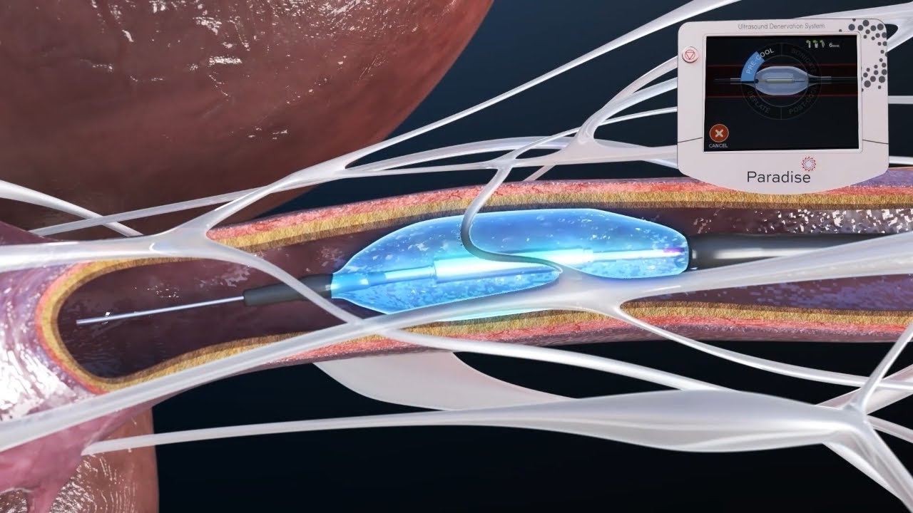 How renal denervation can help control blood pressure without medication