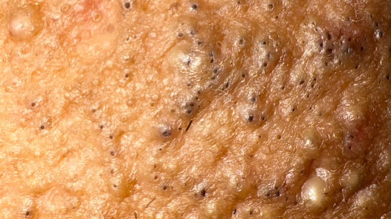 Part 2 Tag skincare removal black heads