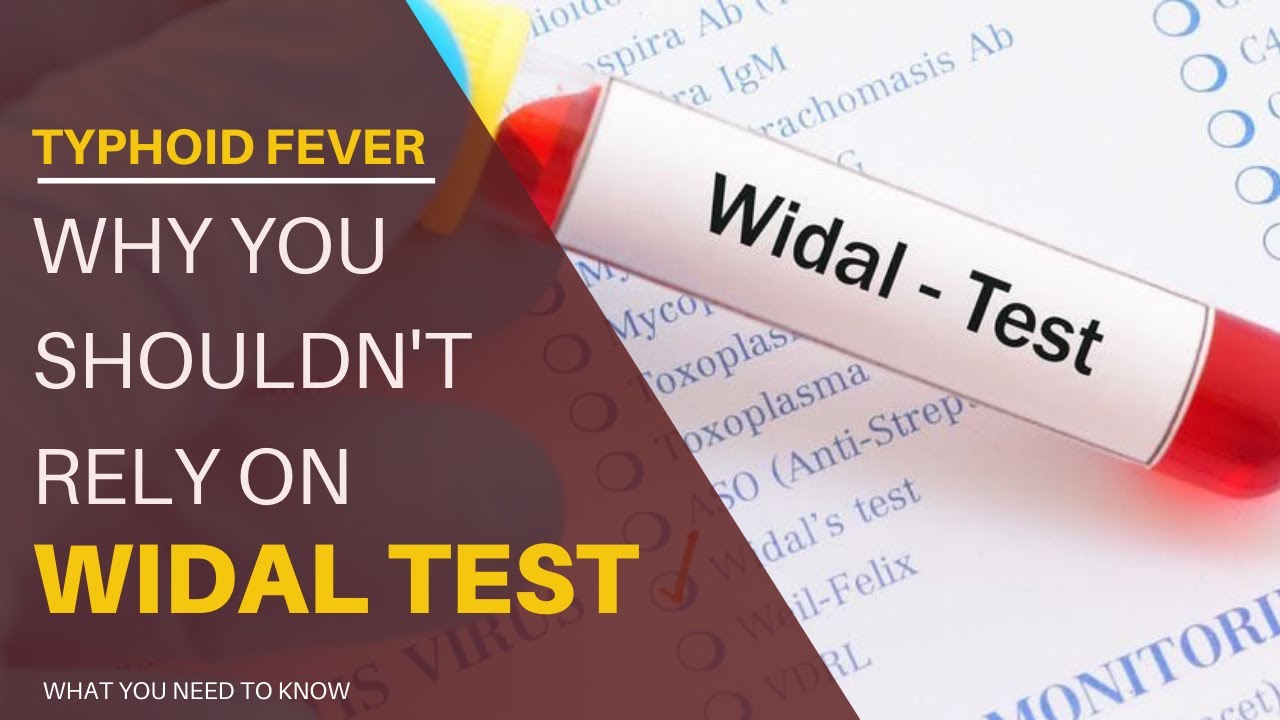 Typhoid Fever: Why You Shouldn't Rely On Widal Test - What You Need To Know