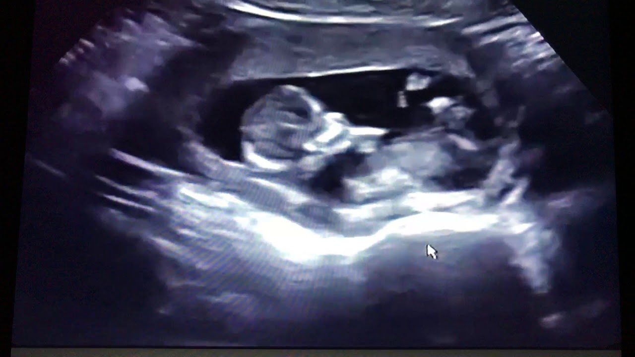 Ultrasound Hidden twin ?