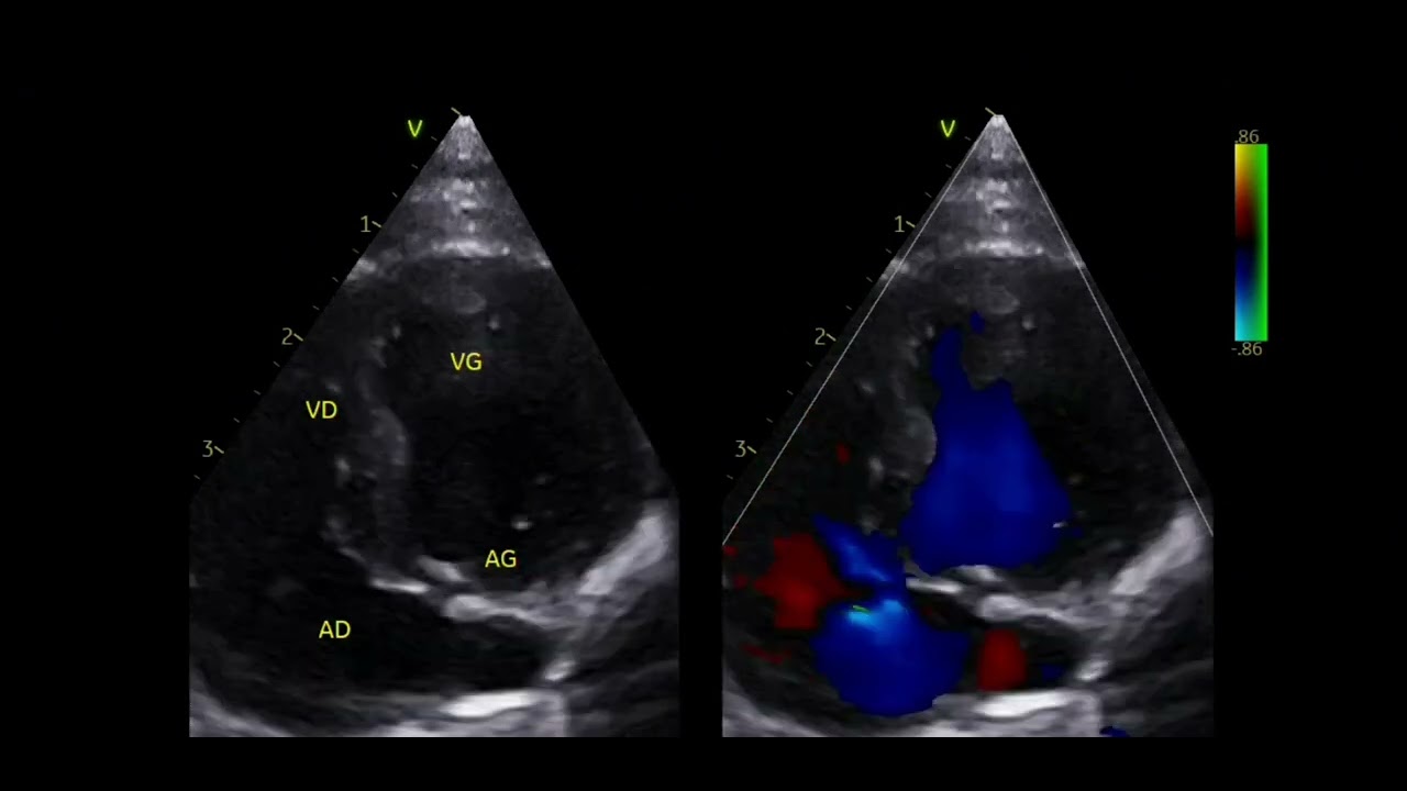 Tricuspid valve dysplasia in a kitten 🐱