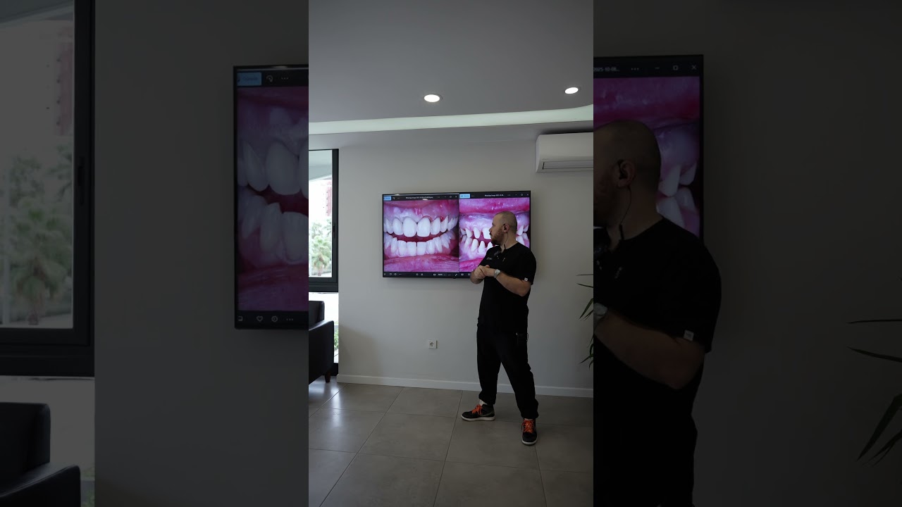 Emax Laminate Veneers & Zirconium Crown  - Dental Clinic Antalya