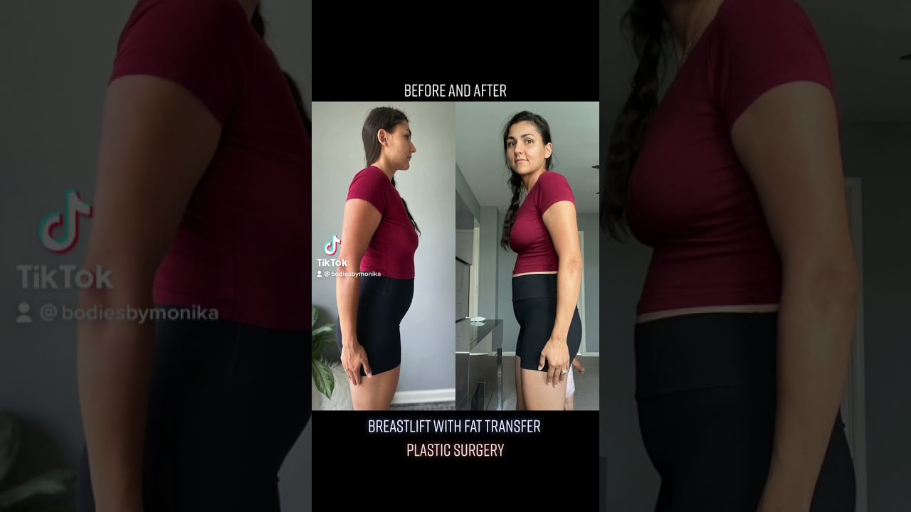 PLASTIC SURGERY Before and After Pictures - Breastlift with Fat Transfer