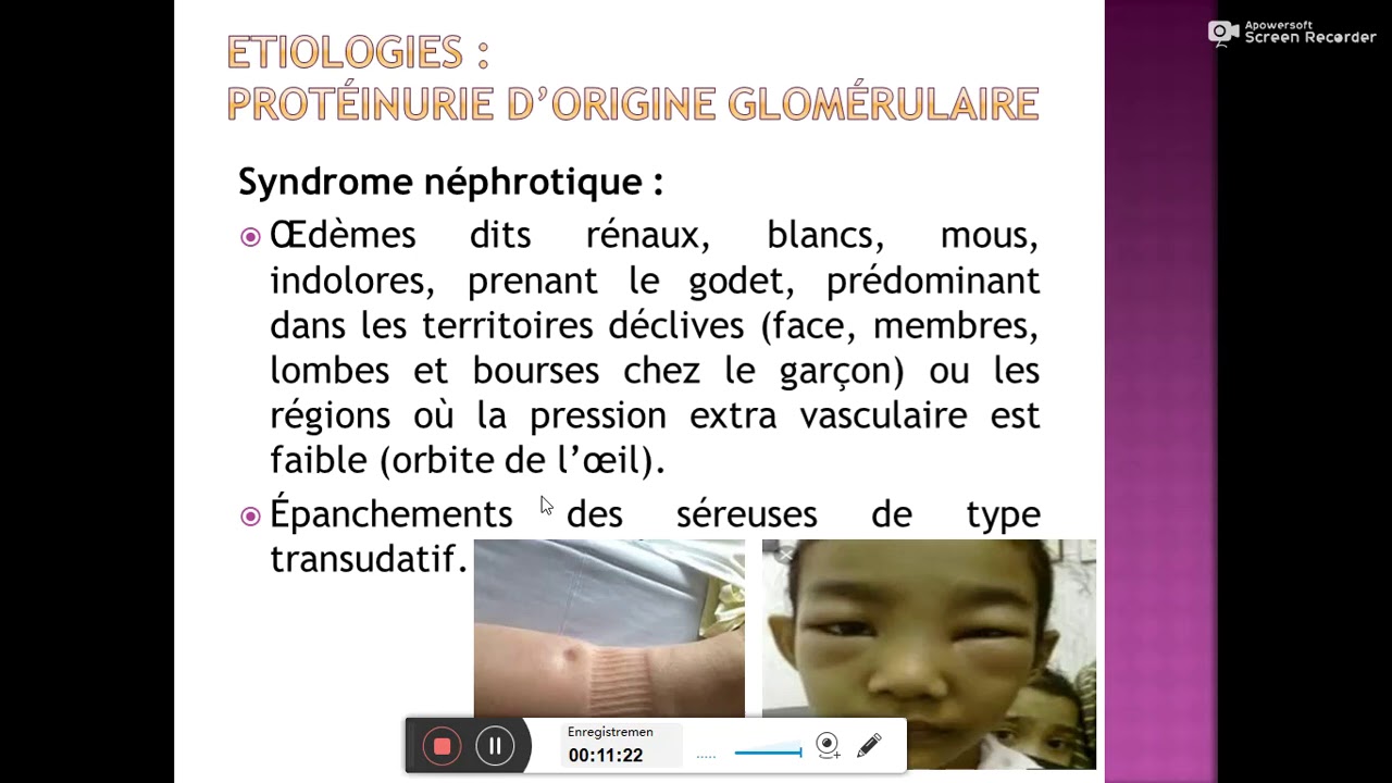 Protéinurie Hématurie Dr M GHARNOUTI
