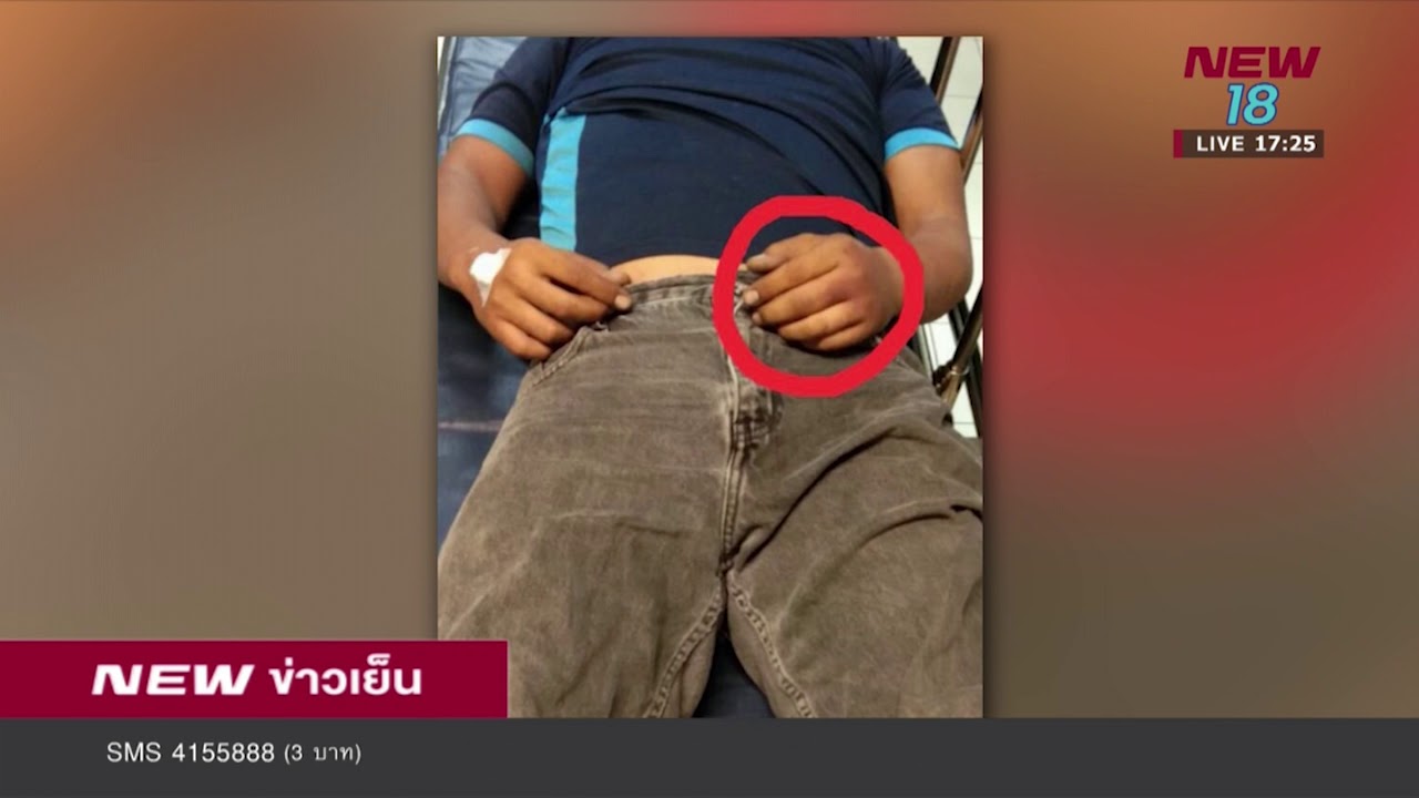 อุทาหรณ์ถึงมือหมอแต่ไม่รอดจากพิษงูเห่า