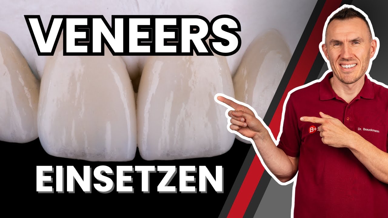 Veneers einsetzen: Wie werden sie angebracht? Zahnarzt erklärt dir das Kleben Schritt für Schritt!