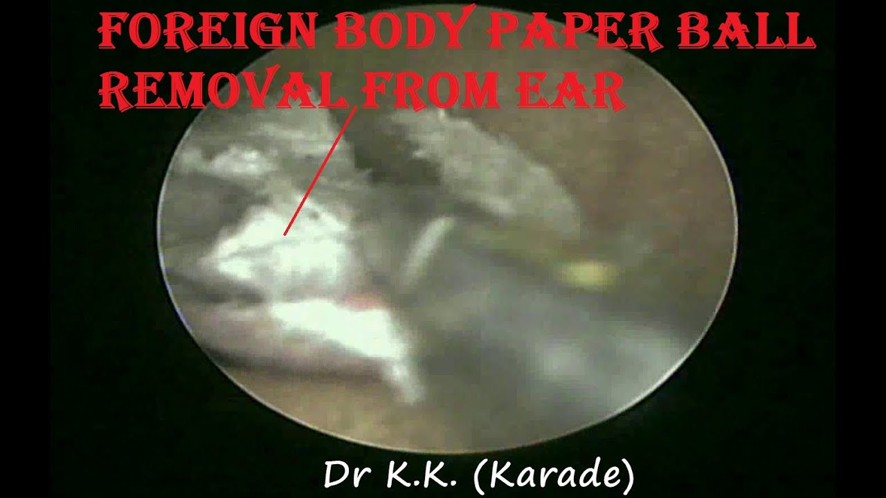 Foreign Body Paper Ball Removal From Ear of 3yr Old Small Girl