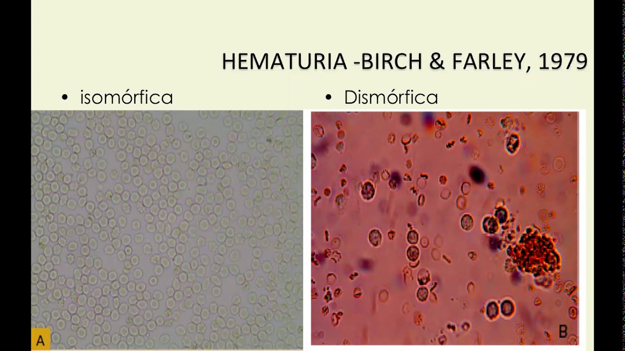 Glomerulopatias - Raciocínio Clínico - Drª Patrícia Abreu