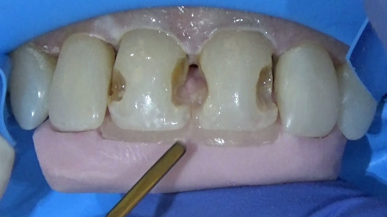 🔴PASSO A PASSO DUAS FACETAS + AUMENTOS INCISAIS EM DENTES TORTOS 🤩