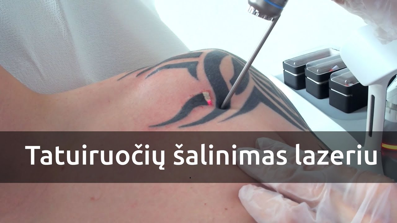 Tatuiruočių šalinimas lazeriu dermatologijos klinikoje