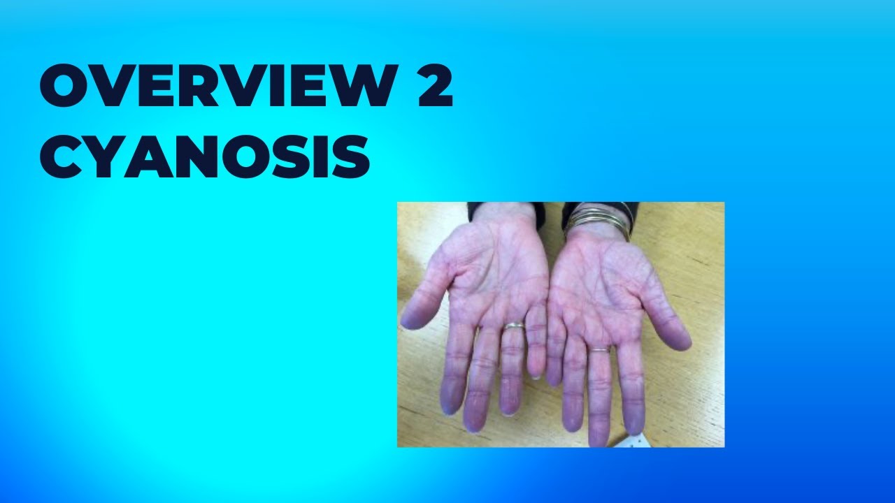Overview 2 :  Cyanosis