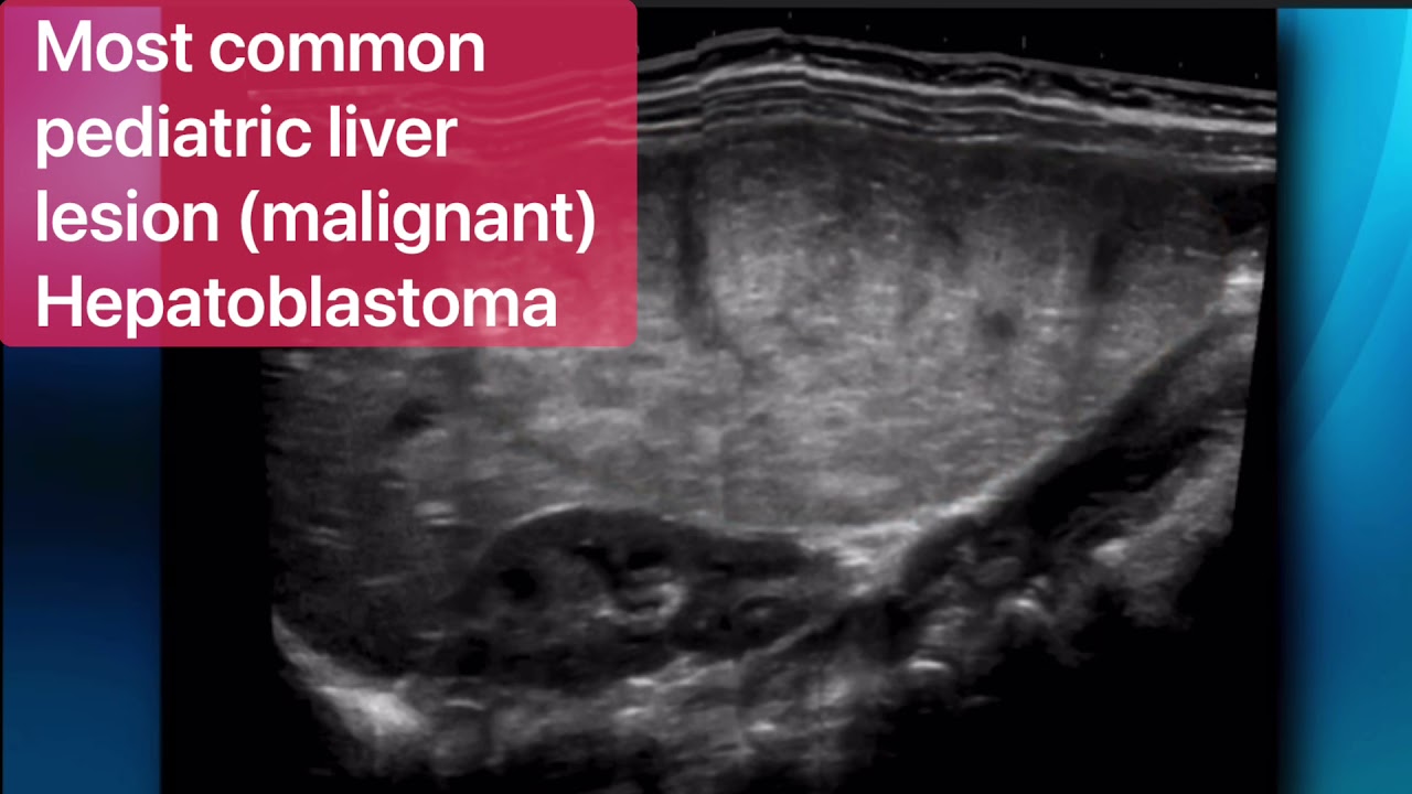 Mesenchymal Hamartoma