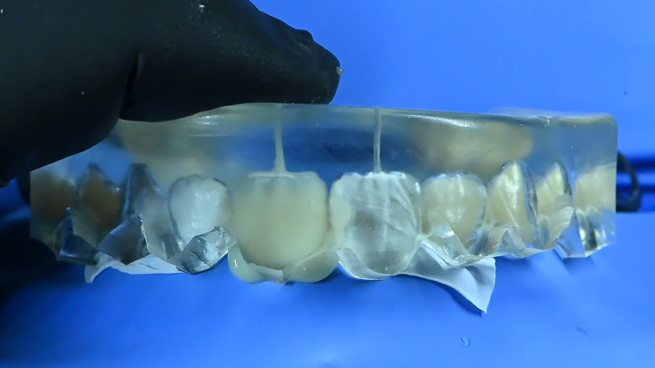 Tecnica BEST.FIT (Buccal Enamel Shape Through Flow Injection Technique) del Dr. Enzo Attanasio