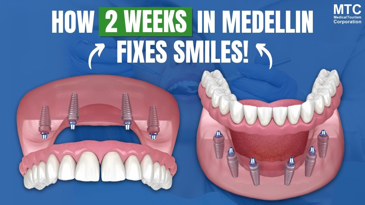 Full Mouth Dental Implants in Medellin: Top Dentist in Colombia Explains It ALL!