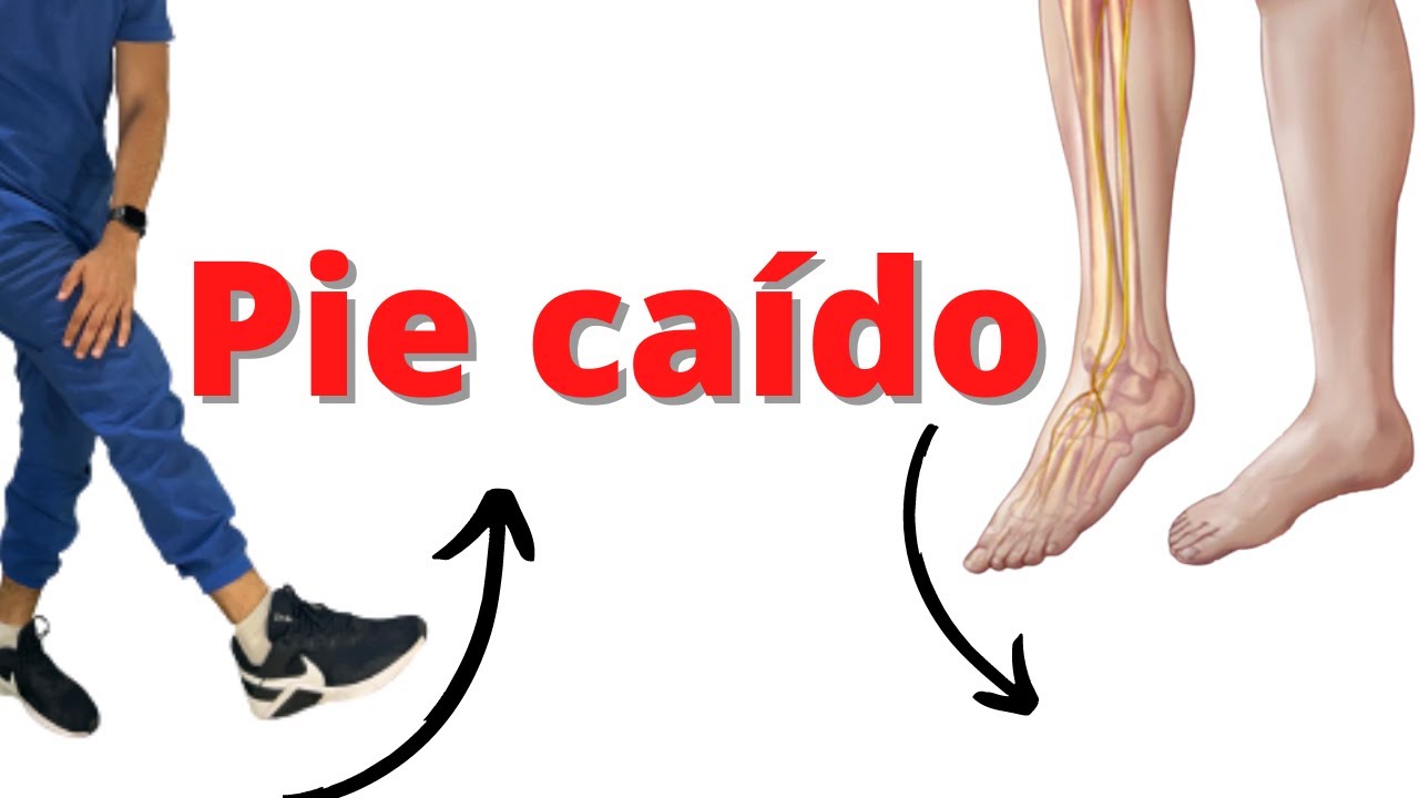 Pie caído ejercicios para estimularlo