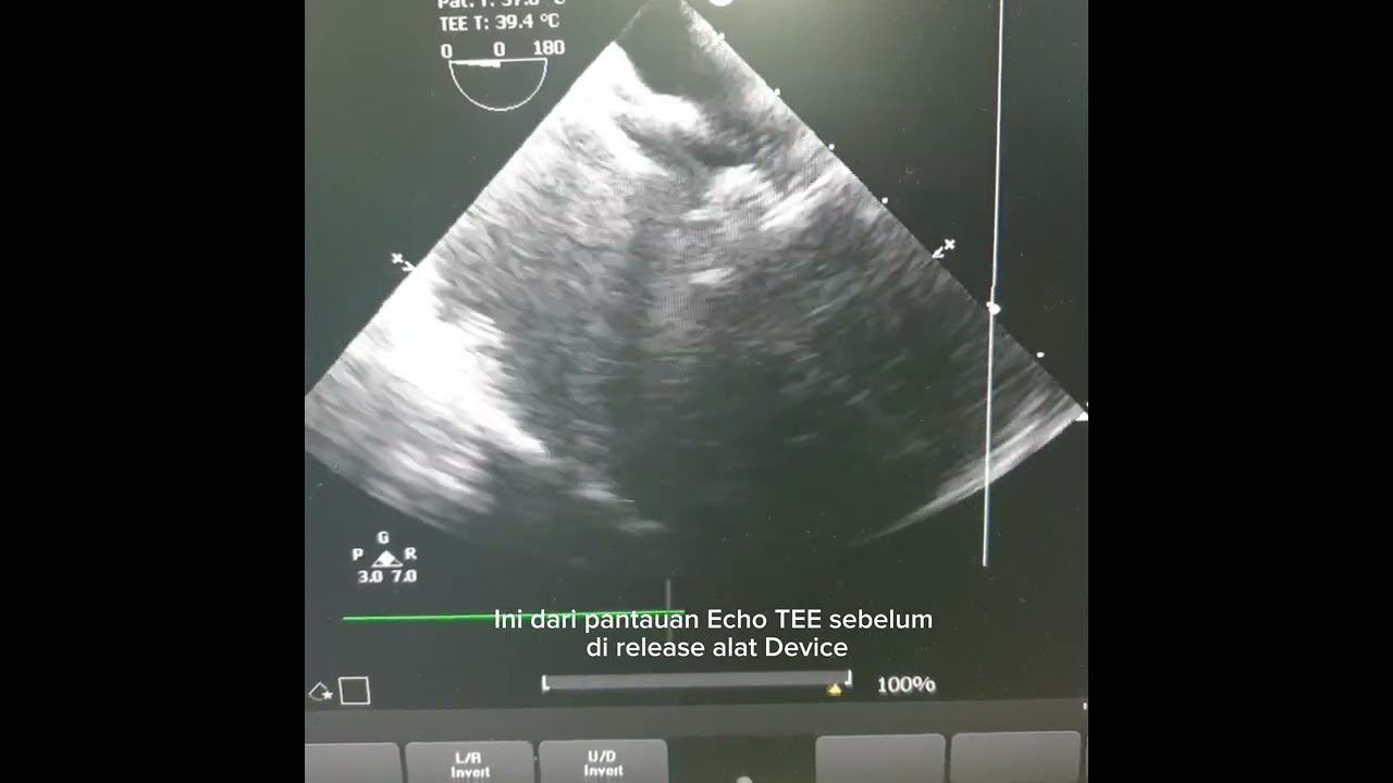 Tindakan tutup jantung bocor ASD (Atrial Septal Defect) pada pasien PJB