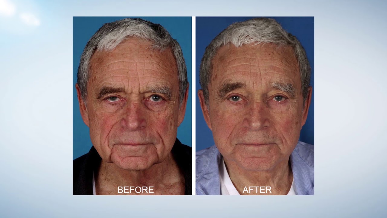 Plastic Surgery for Men - Dr. Bahman Guyuron
