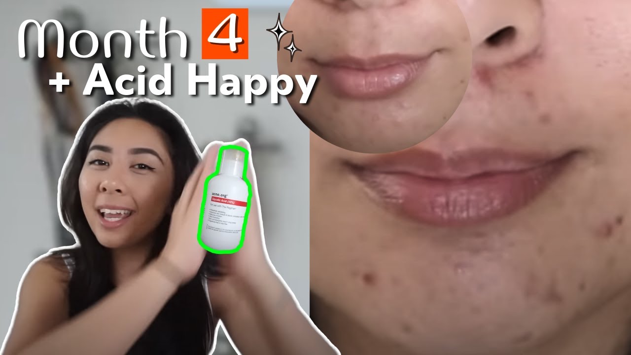 4 Months with AHA and I'm very pleased : ACNE.ORG Skin Journey