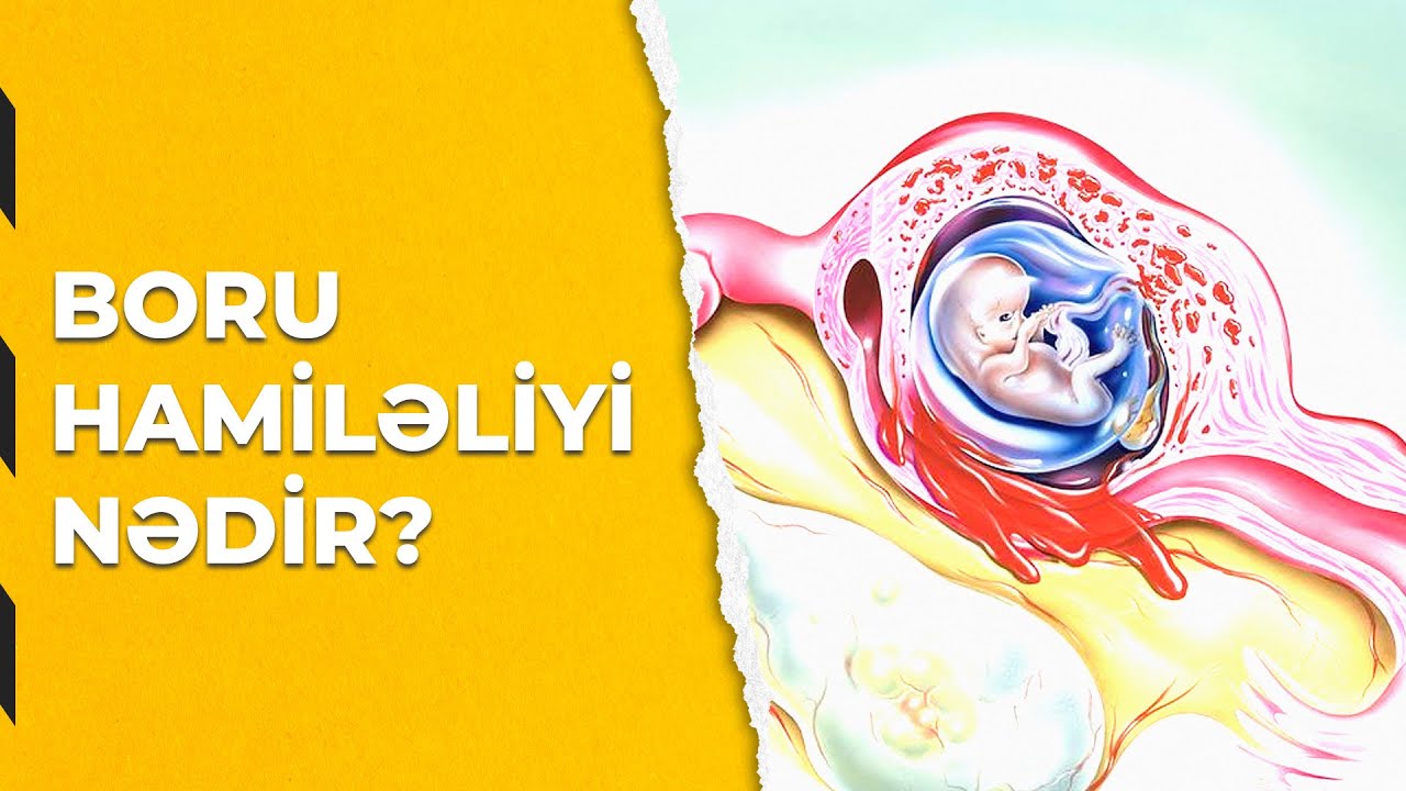 BORU HAMİLƏLİYİ NƏDİR?