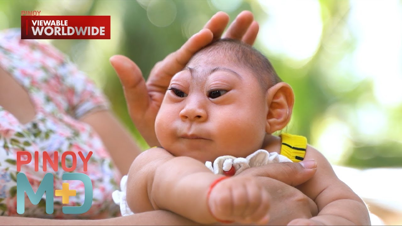 Sanggol, ipinanganak na maliit ang ulo o may kondisyong microcephaly | Pinoy MD
