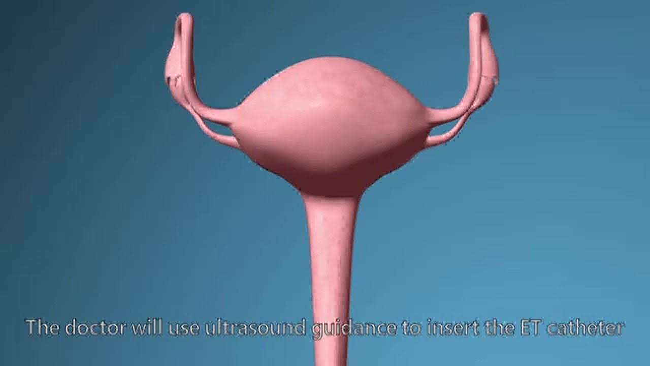 IVF procedure step by step detail explanation