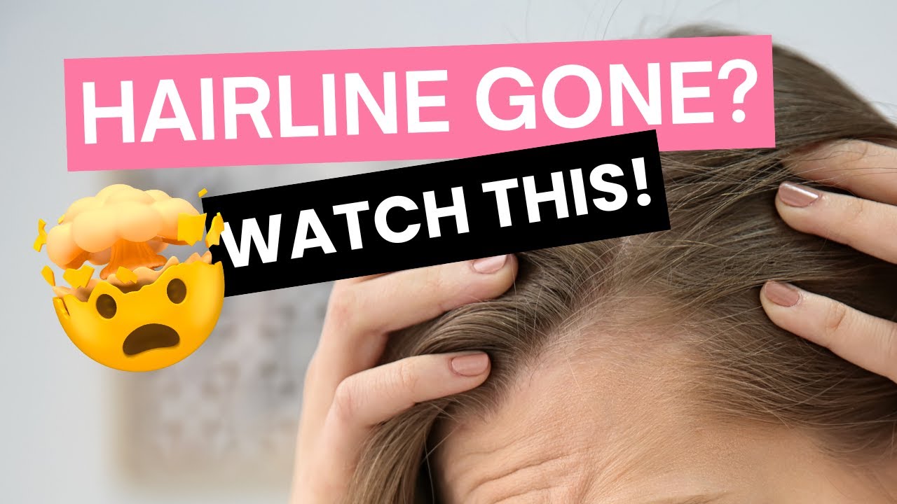 Frontal Halo: Your Hairline Glow-Up!