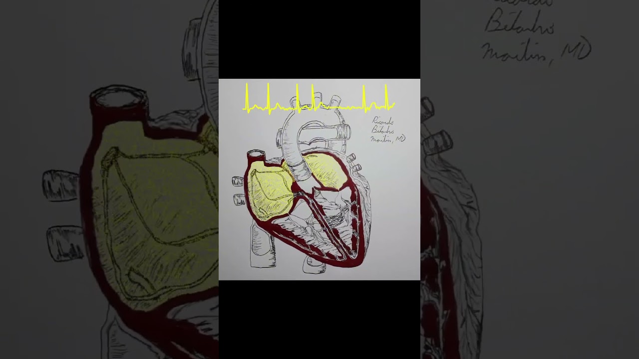 Atrial fibrillation #ekgtech #calciumchannelblockers #paracentesis #ecg #ablation #ecginterpretation