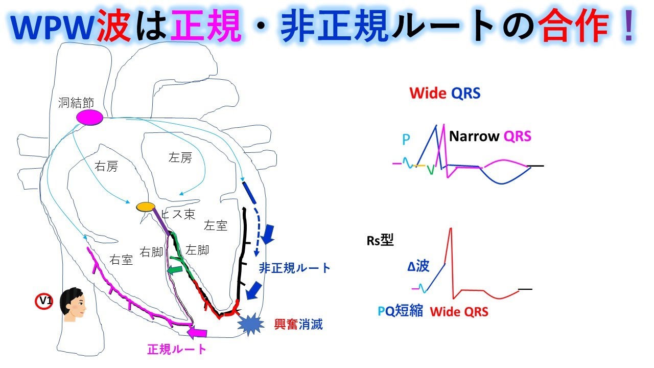 心電図：暗記からの卒業 105話 WPW症候群とLGL症候群