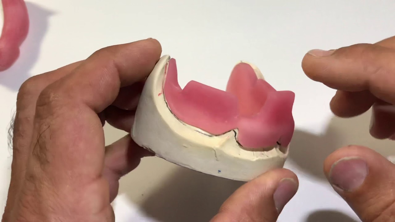 10b) Maxillary & Mandibular Custom Tray Summary